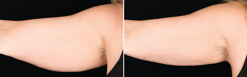 Dr Melinda Silva COOLSCULPTING before and after arms
