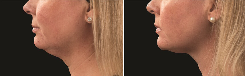 Dr Melinda Silva COOLSCULPTING before and after chin